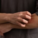 Confirman segundo caso de gusano barrenador en humanos; ahora fue en un hombre de 50 años