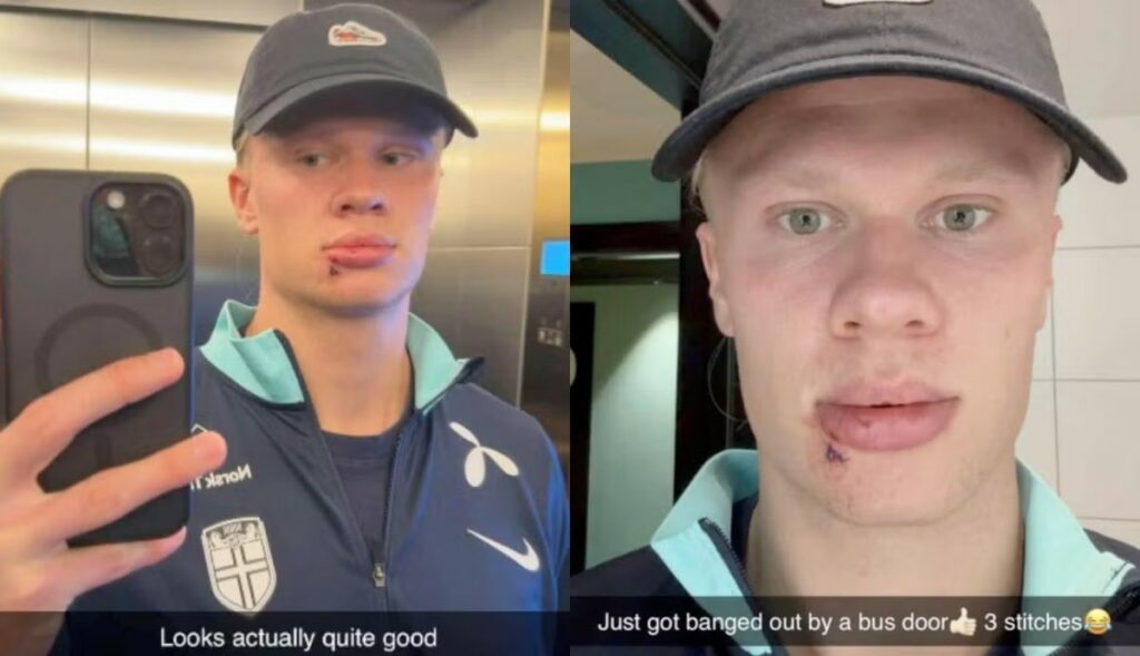 Haaland sufre accidente en autobus y comparte su herida con tres puntos de sutura