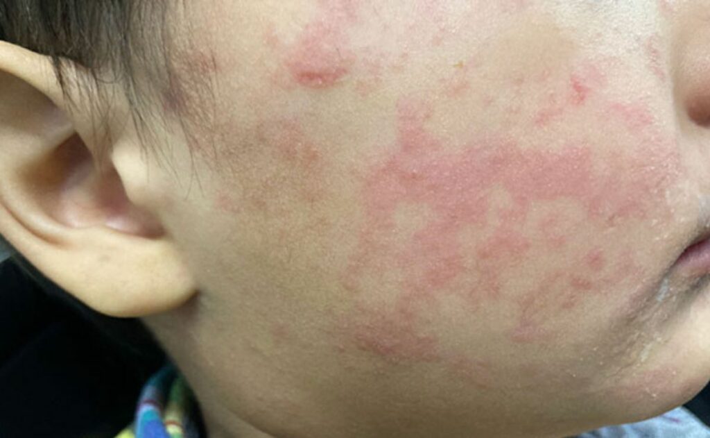 Casos de sarampión se extienden a 25 estados