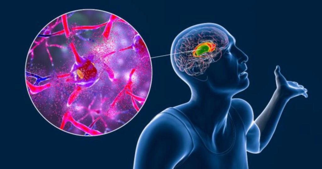 Investigadores ingleses desarrollan nueva inyección para la enfermedad de Huntington