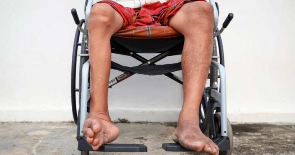 Poliomielitis, enfermedad viral que afecta nervios de médula ósea