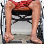 Poliomielitis, enfermedad viral que afecta nervios de médula ósea