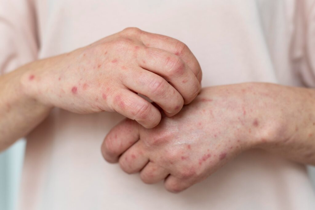 México registra el primer deceso por sarampión en 2026