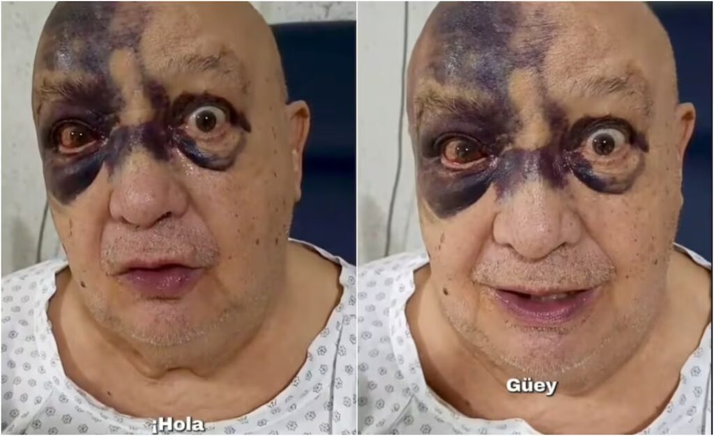 Luis de Alba preocupa tras accidente; reaparece con el rostro cubierto de hematomas